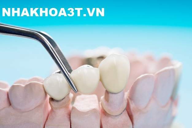 closeup prosthodontics prosthetic teeth crown bridge implant dentistry equipment model express fix restoration 60829 642 2