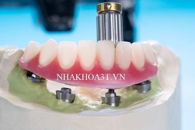 dental implants supporting overdenture blue background 60829 623 1