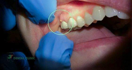 Bọc răng sứ bị viêm tủy