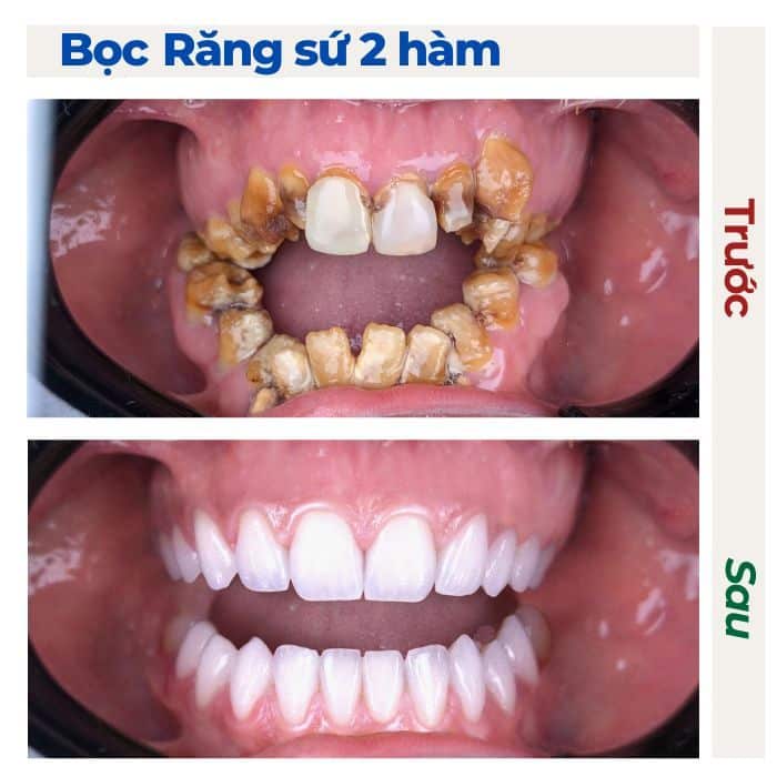 Một trường hợp răng bị hư hỏng nặng cần bọc răng sứ 2 hàm 