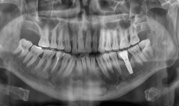 Phim x-quang răng toàn hàm