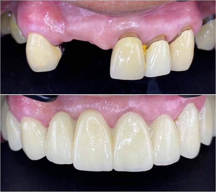 trước và sau khi bọc răng sứ