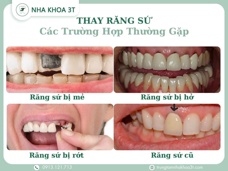 Cac truong hop thuong gap can thay rang su