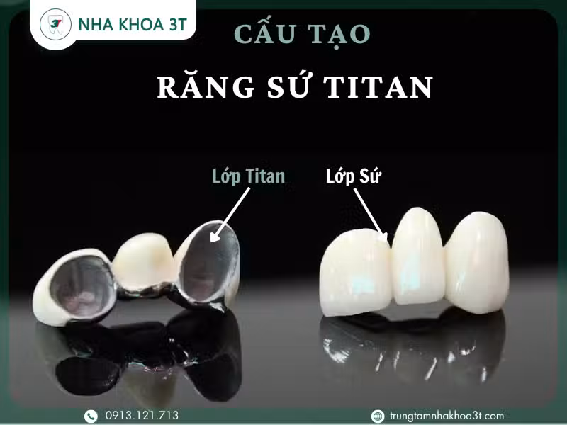 Cấu tạo răng sứ Titan