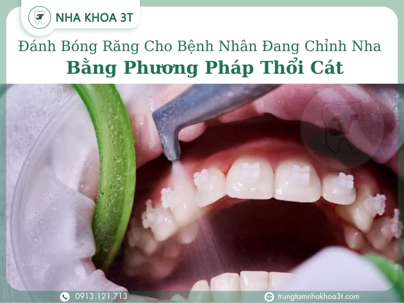 Đánh Bóng Răng Cho Bệnh Nhân Đang Chỉnh Nha Bằng Phương Pháp Thổi Cát