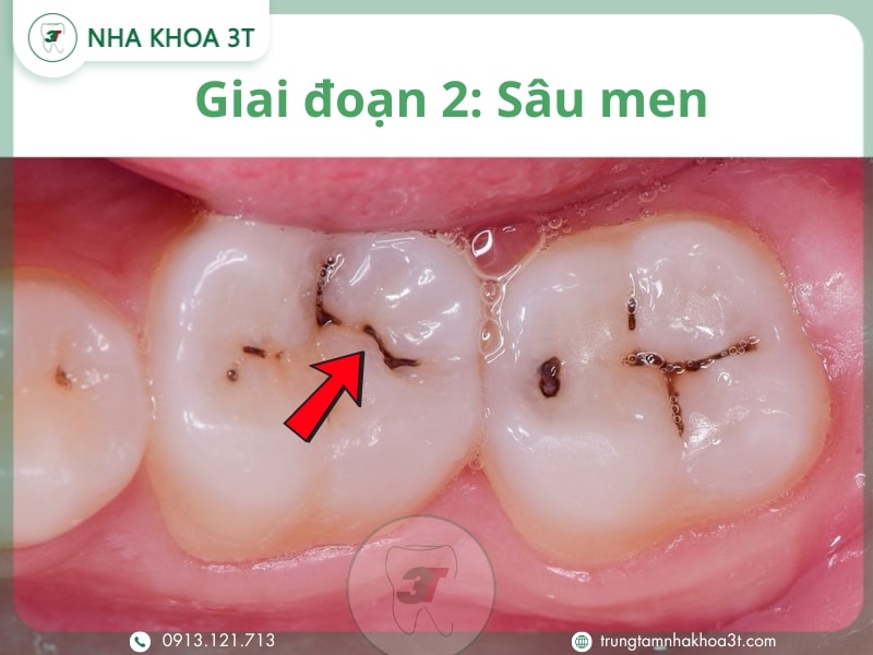 Giai đoạn 2 Sâu men