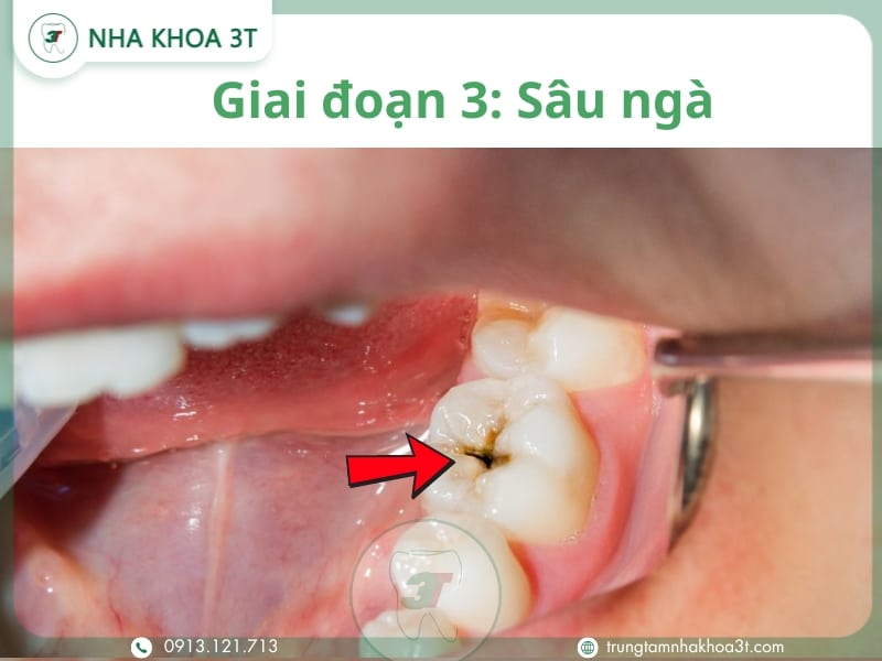 Giai đoạn 3 Sâu ngà