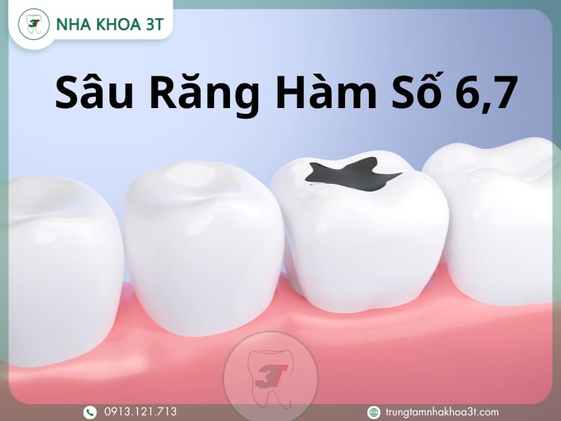 Sâu Răng Hàm Số 6,7