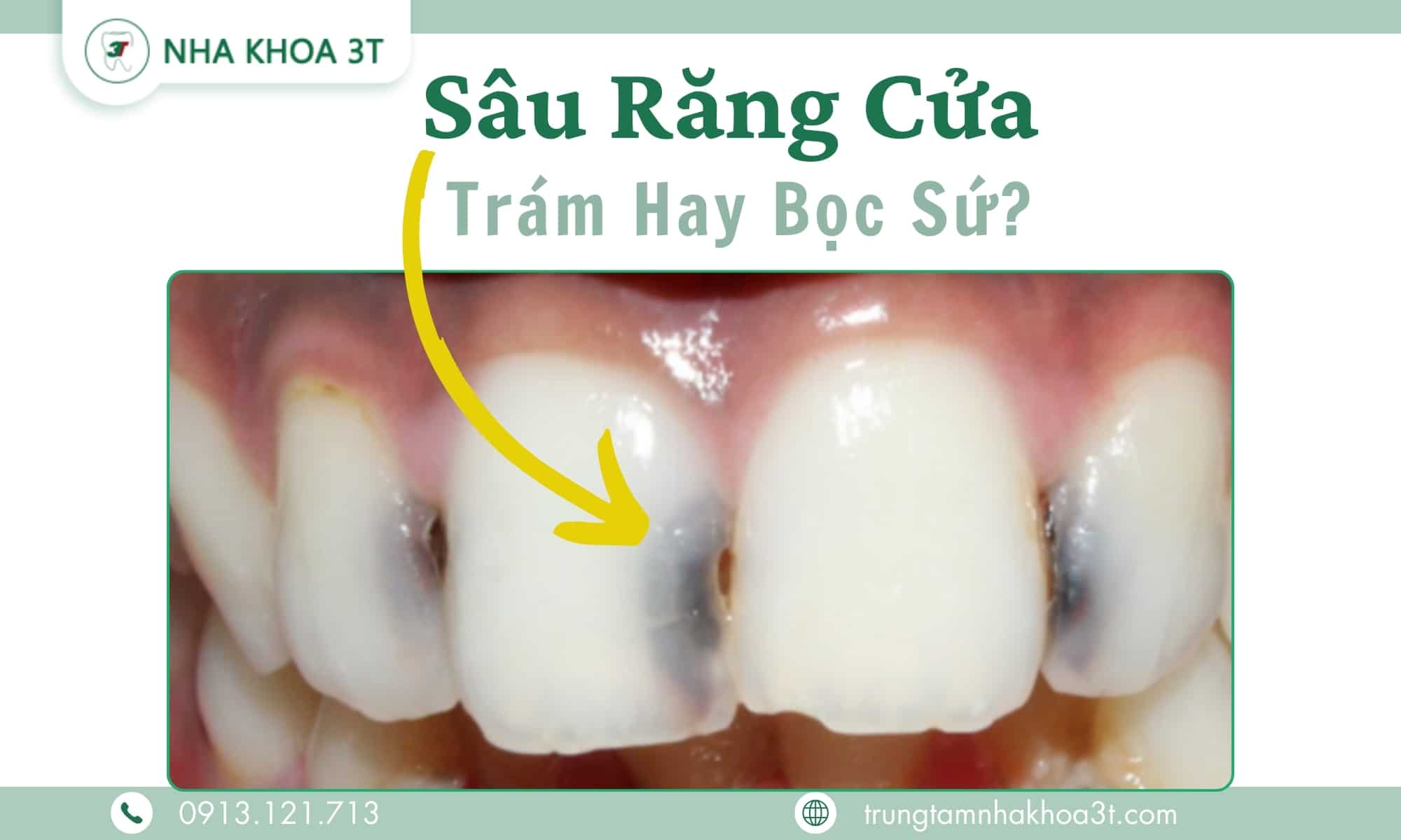 Hình ảnh sâu răng cửa