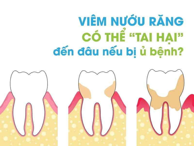 Tác hại của bệnh viêm nướu răng