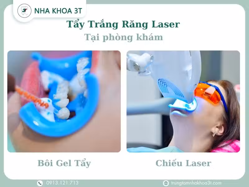 Tẩy trắng răng Laser tại phòng khám 90 phút