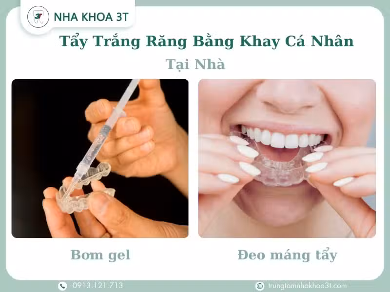 Tẩy trắng răng tại nhà