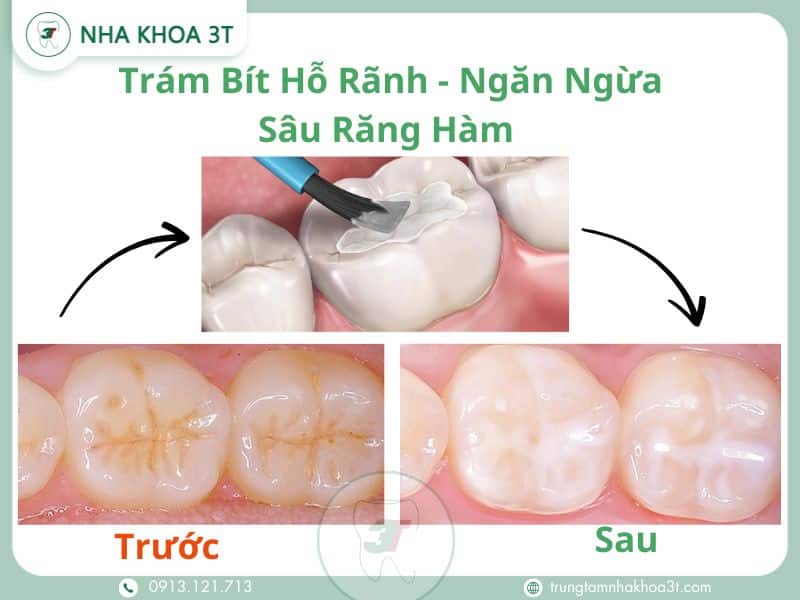 Trám Bít Hỗ Rãnh - Ngăn Ngừa Sâu Răng Hàm