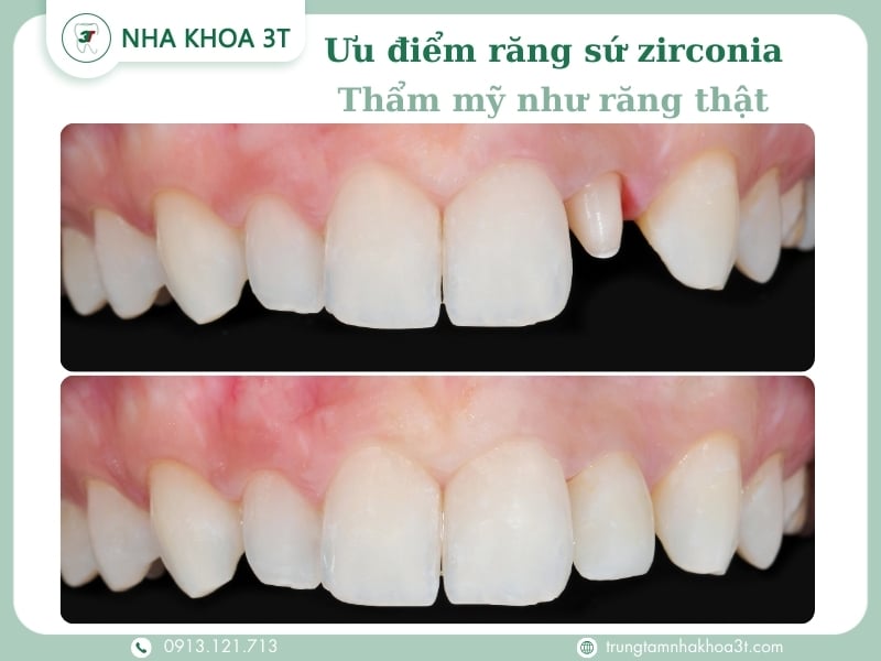 Ưu điểm răng sứ zirconia