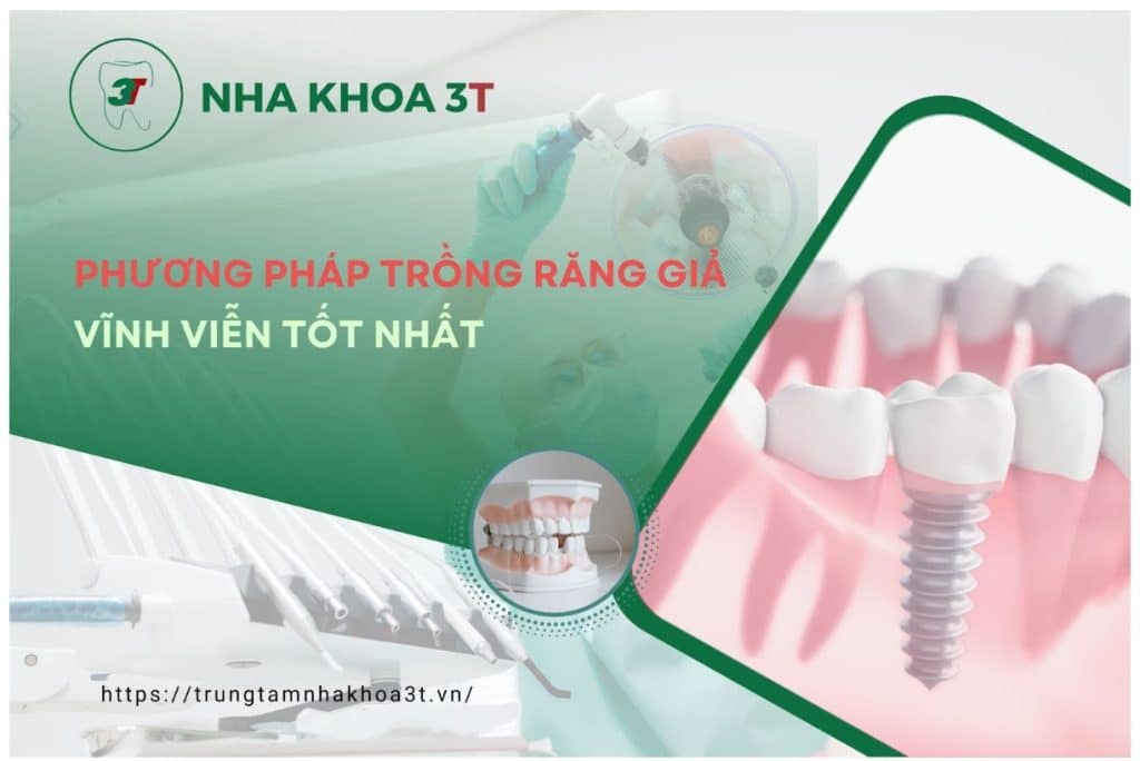 Các phương pháp trồng răng tối ưu nhất được cộng đồng tin tưởng