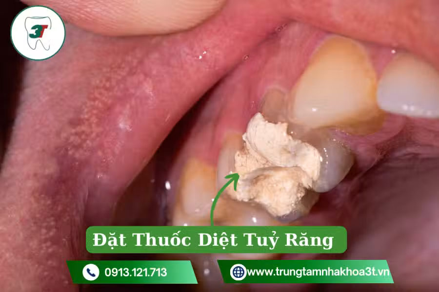 Thuốc diệt tuỷ được đặt bên dưới lớp trám tạm