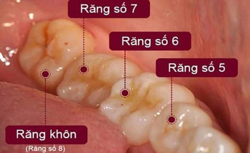 Răng khôn mọc thẳng