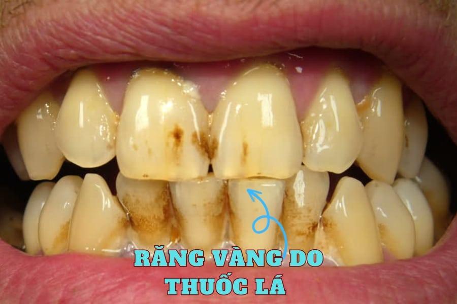 răng vàng do thuốc lá