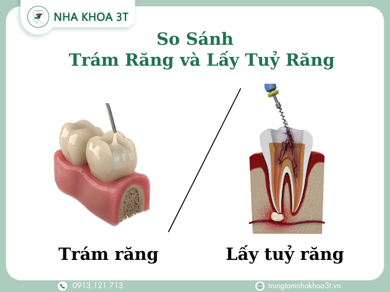 so sánh Trám Răng và Lấy Tuỷ Răng