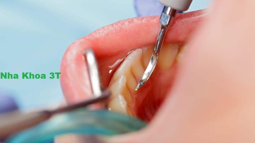 Bạn có biết tác hại của vôi răng?
