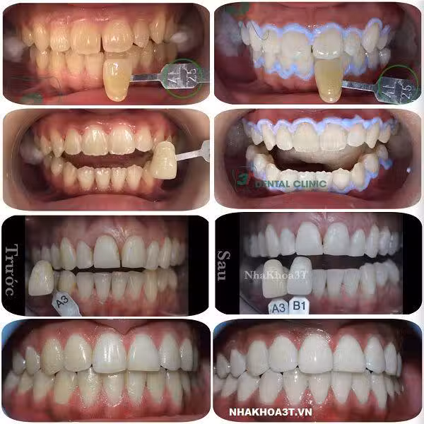 Một số hình ảnh so sánh trước và sau khi tẩy trắng răng