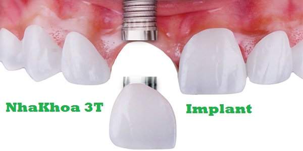 Quy Trình Cấy Ghép Implant & Trồng Răng Implant Có Đau Không?