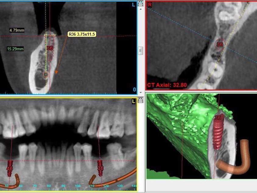 Cắm Implant Khi Mất Một Răng & Quy trình Cấy Ghép Một Răng Implant
