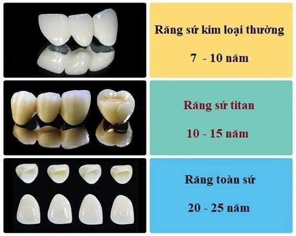 Tuổi thọ trung bình của các loại răng sứ