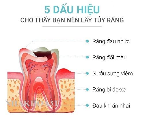 Nội nha (chữa tủy) & Nha khoa tp Hồ chí Minh