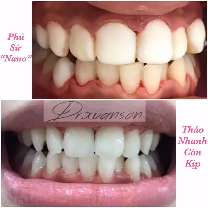 Tháo phủ sứ nano