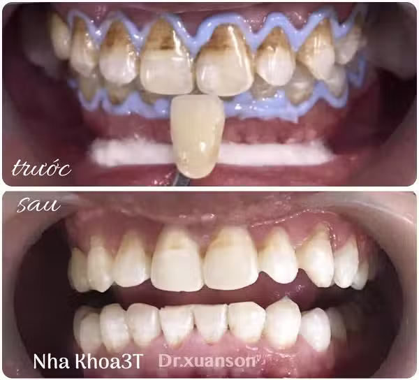Một số trường hợp răng bị nhiễm màu bẩm sinh có thể cần nhiều lần tẩy mới hiệu quả