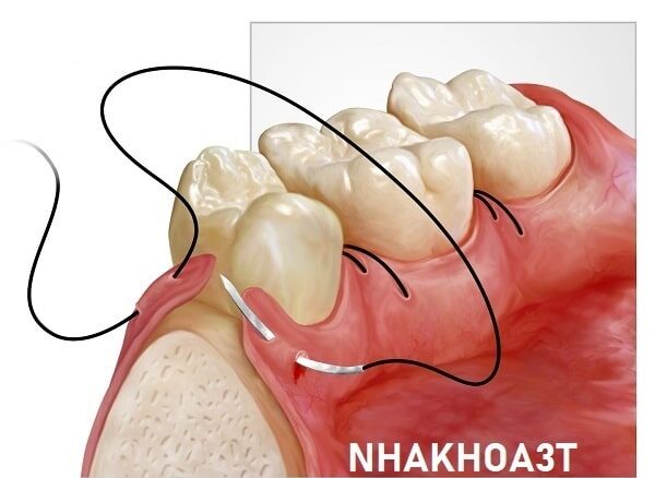 Chỉ khâu sau khi nhổ răng khôn