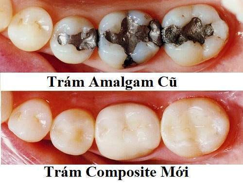 Thay miếng trám amalgam bằng miếng trám composite