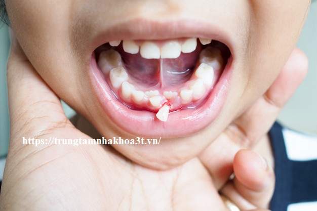 baby tooth asian thai girl children with teeth dropped out from gums kids dental health problems 43520 212 3
