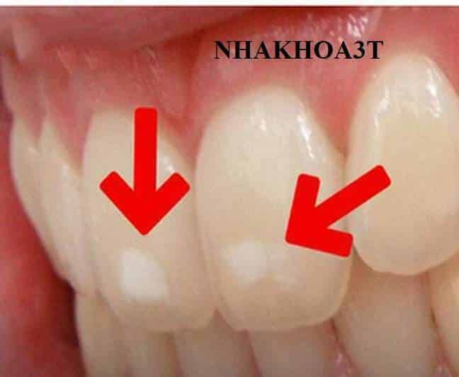 Lợi Ích Của Fluor & Cách Sử Dụng FLuor Trong Phòng Ngừa Sâu Răng