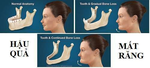 consequences of tooth loss