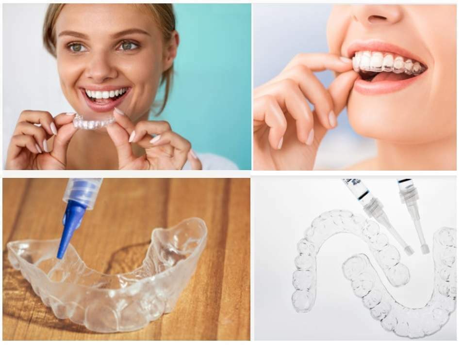 [Hỏi Đáp]Kiêng gì sau khi tẩy trắng răng & Sau bao lâu có thể tẩy trắng răng trở lại?
