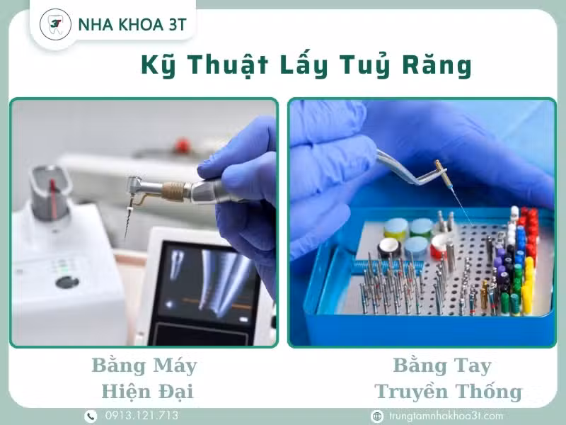 Máy lấy tủy răng tự động
