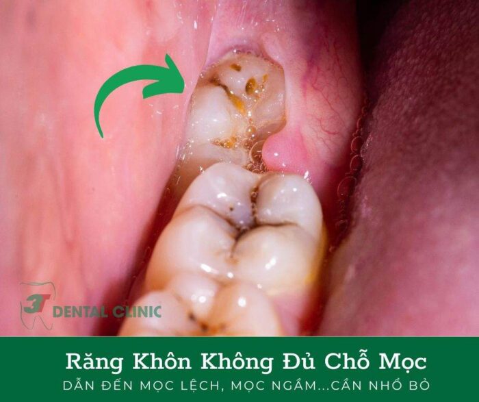 răng khôn mọc lệch