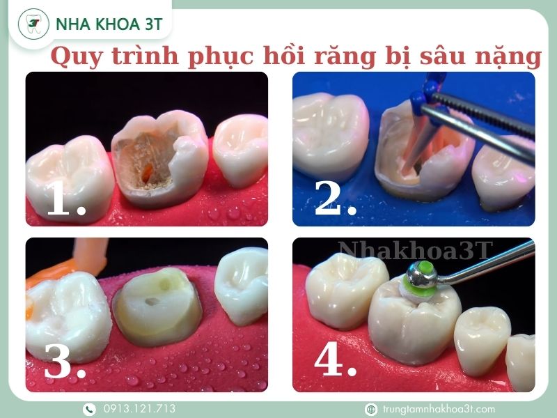 1. Răng bị sâu nặng, 2. Lấy tuỷ răng, 3.Tái tạo cùi, 4.Lắp răng sứ