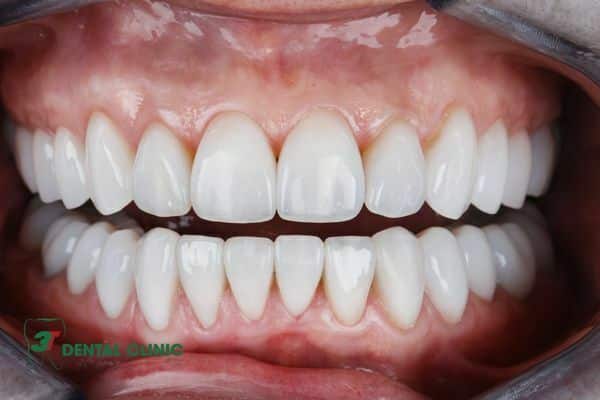 Trồng răng sứ nguyên hàm