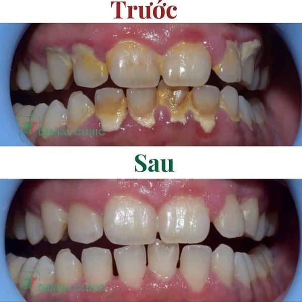 cao-voi-rang-truoc-sau-1