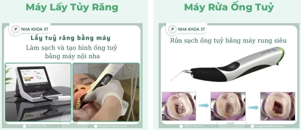 Công nghệ hiện đại giúp lấy tuỷ răng không đau và rút ngắn thời gian điều trị đáng kể.