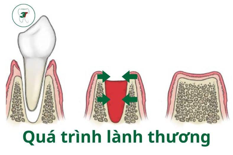 qua trinh lanh thuong sau khi nho rang