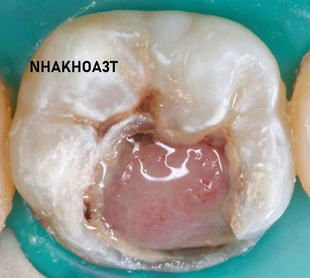 Hình ảnh răng sâu lồi thịt trong miệng