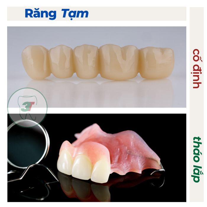 các loại răng tạm dùng sau khi nhổ răng
