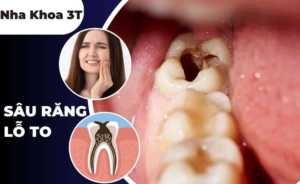Sâu răng lỗ to khiến bạn đau răng kinh khủng!