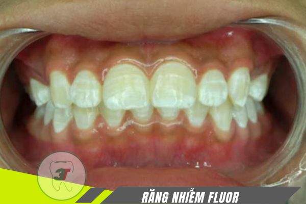răng nhiễm fluor