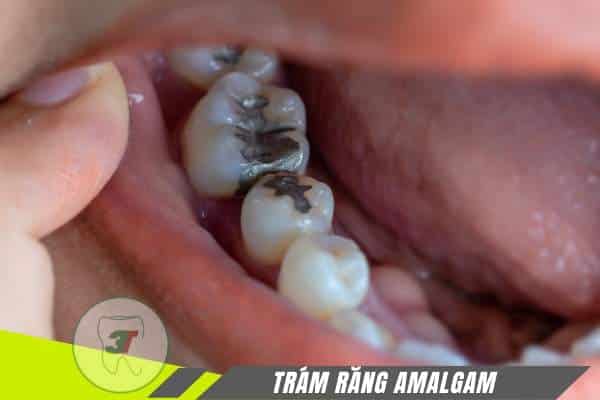 trám răng amalgam