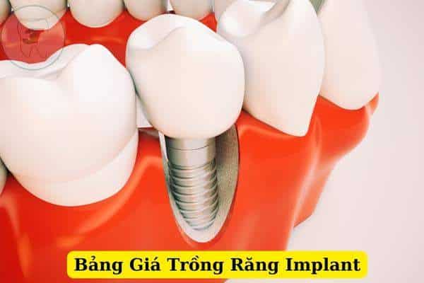 Bang Gia Trong Rang Implant